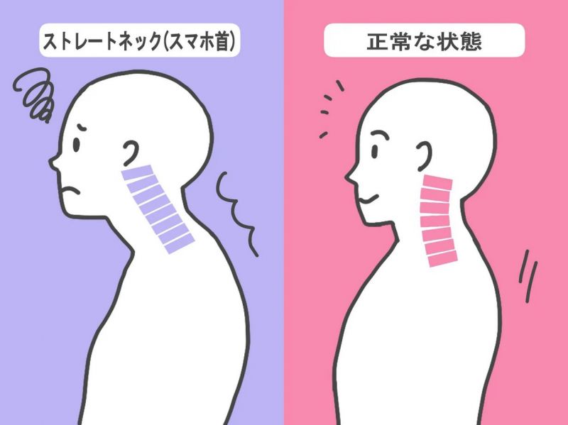 tình trạng cổ rùa